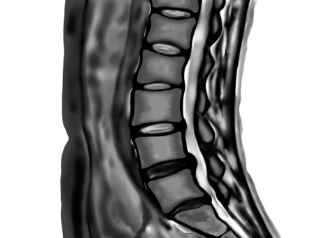 عرق النسا - د مخ واعصاب مصر الجديدة - دكتور خالد عبدالمقصود - افضل دكتور مخ واعصاب - دكاترة المخ والاعصاب .